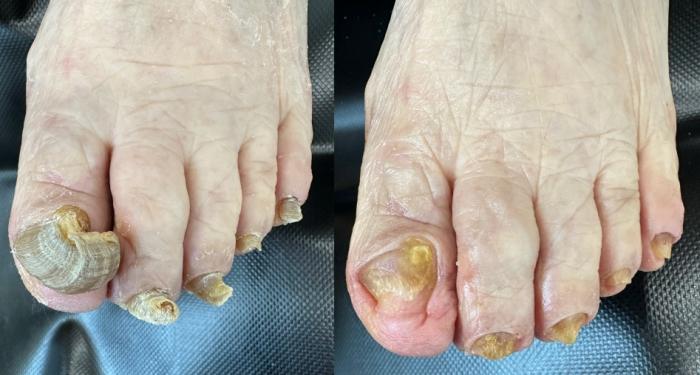 발톱 하나가 어르신의 하루 전체를 바꾼다사진제공실버풋