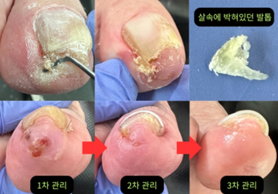 어르신 발톱관리 과정제공실버풋